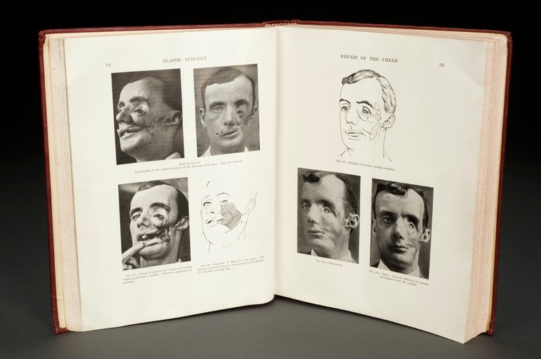 'Plastic Surgery of the Face' by Harold Gillies, London, Eng. Credit: Science Museum, London.